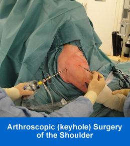 Arthroscopic Surgery of the Shoulder