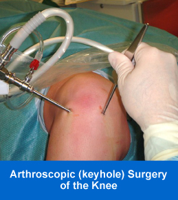 Arthroscopic Surgery of the Knee